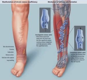 Venous Insufficiency Overview | Treatment of Venous Insufficiency