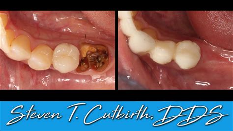 Lower Molar Extraction