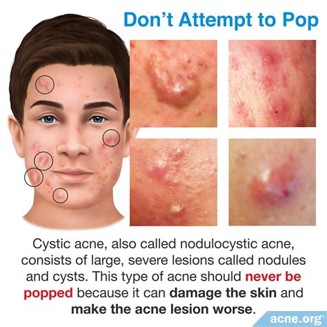 Cystic Acne Pop