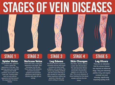 Varicose Vein Treatments - What are the Best?