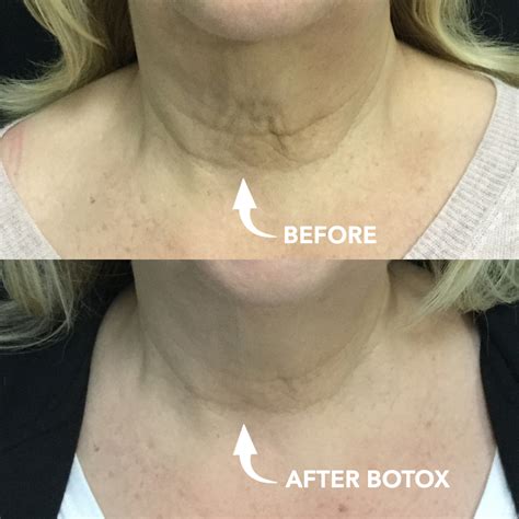 Micro Botox | Usha Rajagopal, MD