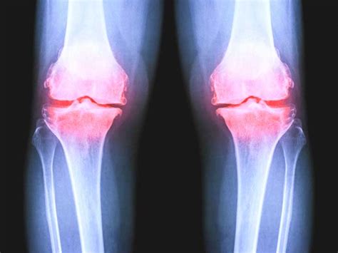 Osteoarthritis of the Knee X-Ray