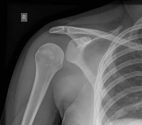 Posterior Shoulder Dislocation • LITFL • Trauma Library