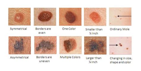 Small Red Moles On Skin: Everything You Need To Know