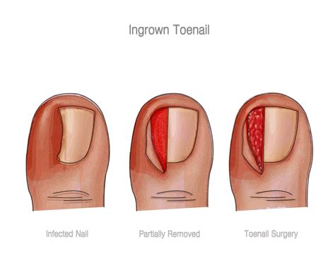 Partial Toenail Avulsion Treatment - Nail Ftempo