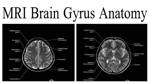 MRI Brain Gyrus Anatomy - YouTube