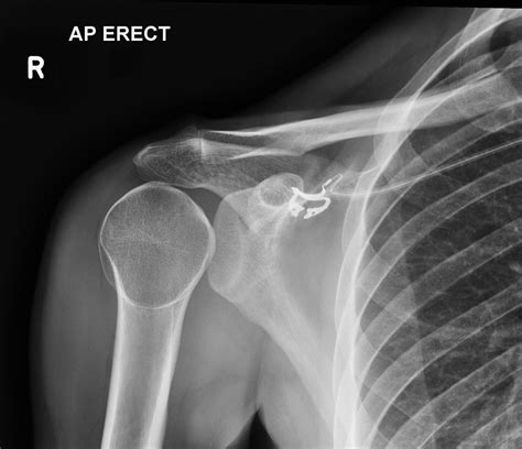 Posterior Shoulder Dislocation X Ray - WaylonjoysSteele