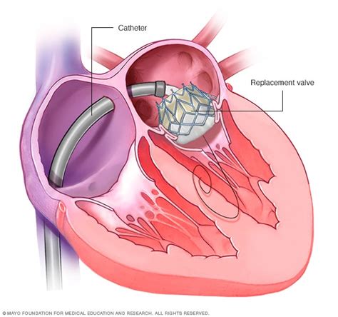 Transcatheter mitral valve replacement - Mayo Clinic