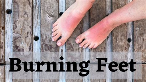 Burning Feet: Know its Symptoms, Causes and Home Remedies