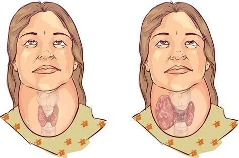 Qué es el bocio, sus causas, factores de riesgo y tratamientos naturales