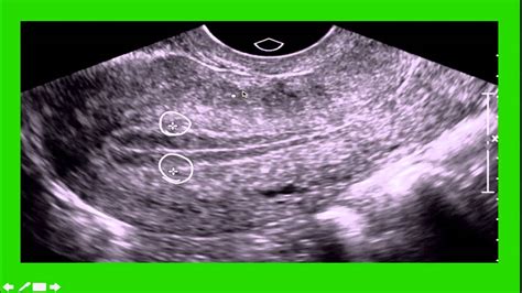 GYN Ultrasound - YouTube