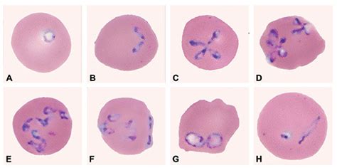 Figure 2 - Babesia divergens–like Infection, Washington State - Volume ...