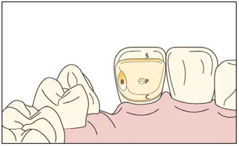 Minimally Invasive Bonded Bridges vs Implants | Dental Jay