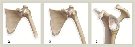 Surgical management of shoulder arthritis - Surgery - Oxford ...