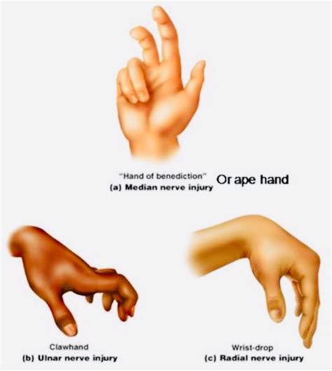 Hand Nerve Injuries MNEMONIC - MEDizzy