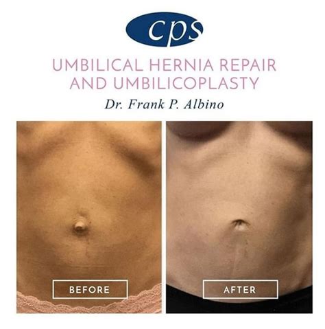 #BeforeandAfter - Umbilical Hernia Repair and Umbilicoplasty Center for ...