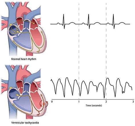 Ventricular tachycardia causes, symptoms, diagnosis, prognosis & treatment