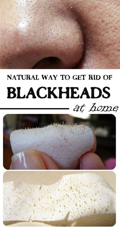 Easy & Super Working Natural ways to get rid of blackheads, at Home ...