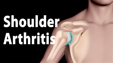 Glenohumeral Joint Arthritis - Carolina Regional Orthopedics