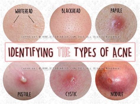 Acne Nodule Vs Cyst