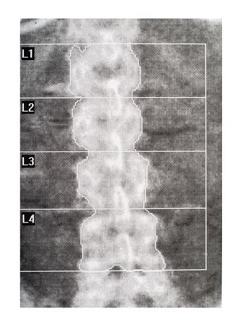 Bone Density Dexa Scan Osteoporosis Diagnosis Stock Photo - Download ...