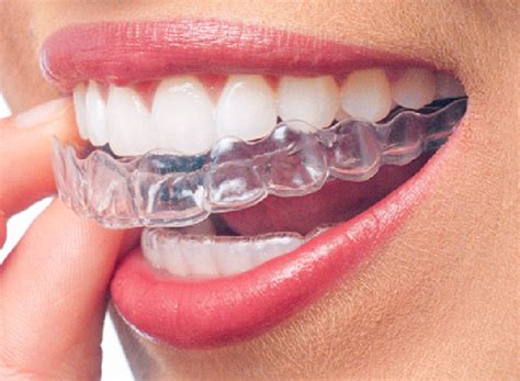 Clear Braces to Optimize Your Smile! | Daniel N. Galaif, D.D.S ...