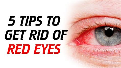 REMEDIES TO GET RID OF RED EYES. - YouTube