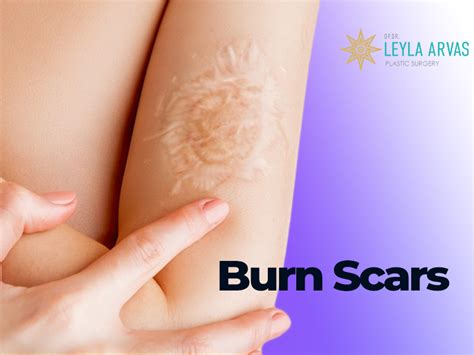 Burn Scars - Expert Advice and Treatment Options - 2024