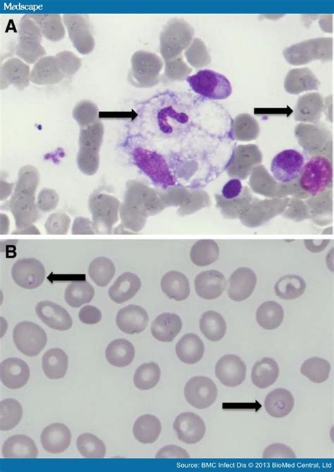 Babesia microti - Page 3