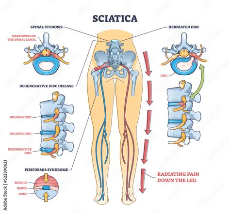 Sciatica pain or nerve weakness as leg lumbar radiculopathy outline ...