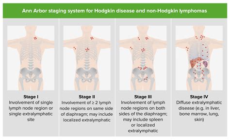 Linfoma de Hodgkin | Concise Medical Knowledge