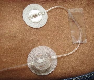 Infusion Set Failure - Diabetesnet.com