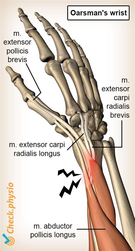 Oarsman's wrist | Physio Check