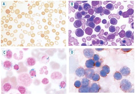 Ring sideroblasts and sideroblastic anemias | Haematologica