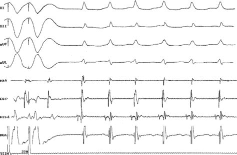 Transient RV apical pacing during arrhythmia with 1:1 VA conduction ...