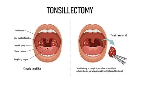 Tonsillectomy - 150 Harley Street ENT