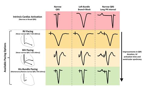 Pacing supplement: His-bundle pacing - UK experience and HOPE for the ...