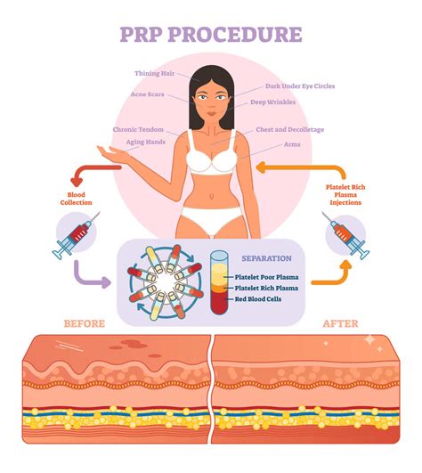 PRP Treatments - O3 Ozone Med Spa