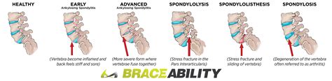 Spondylosis | The Most Confusing Spine Condition Explained