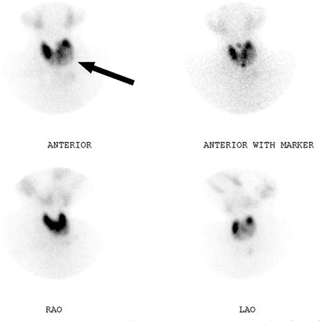 Thyroid: nuclear medicine update. | Semantic Scholar