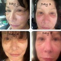 Lower Facelift Recovery Photos » Facelift: Info, Prices, Photos ...