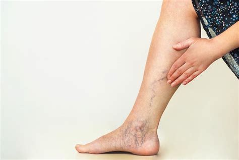 When Varicose Veins Are Symptomatic: Woodlands Heart and Vascular ...