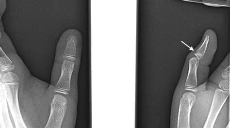 THUMB DISTAL PHALANX PEDIATRIC FRACTURE | Hand Surgery Source