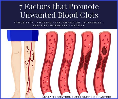 Tips for Blood Clot Prevention | Home Cures That Work