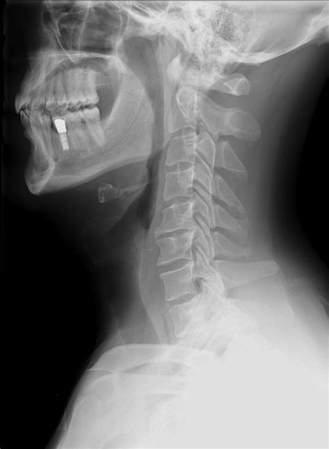 Cervical Spine X Ray Anatomy