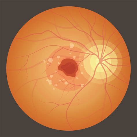 What Causes Macular Edema? - Elman Retina Group