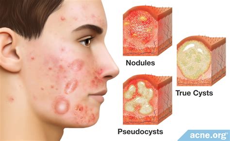 What Is Cystic Acne? - Acne.org