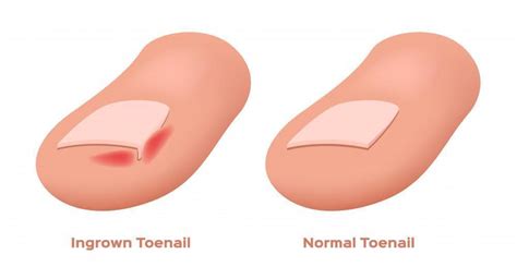 What Causes Ingrown Toenails?: The Foot & Ankle Specialists: Podiatric ...