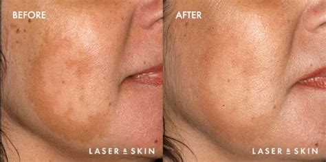 Fractional Non-Ablative Laser | Aging Skin Treatment | Sacramento CA