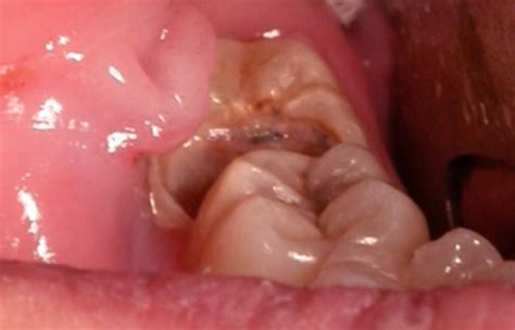 Wisdom Tooth Infection - Symptoms, Causes, Treatment, Pictures - (2018 ...